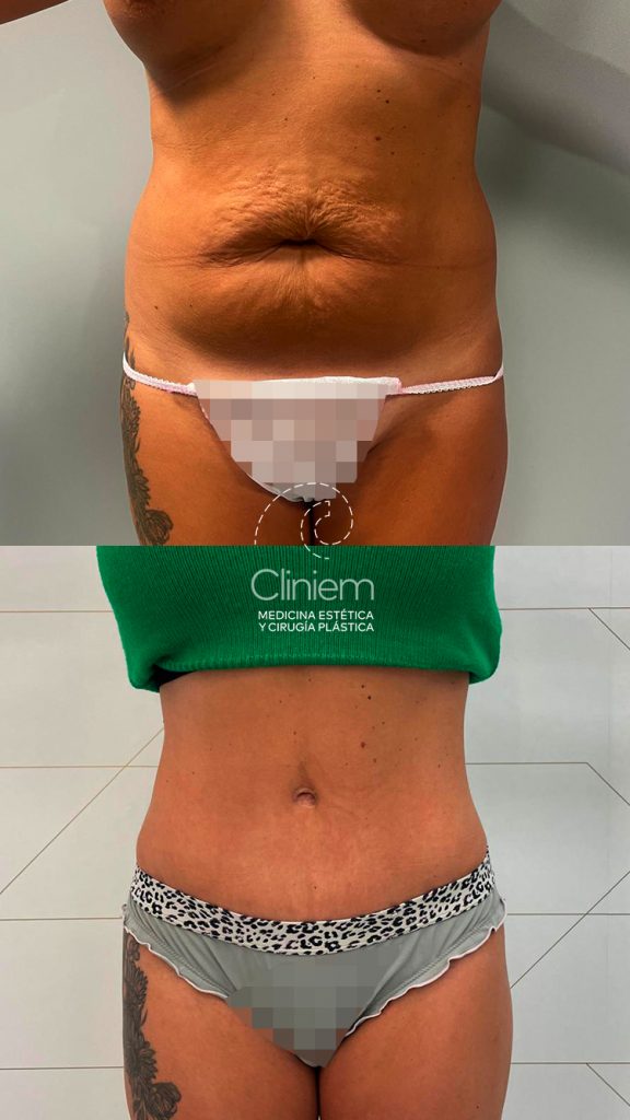 ABDOMINOPLASTIA