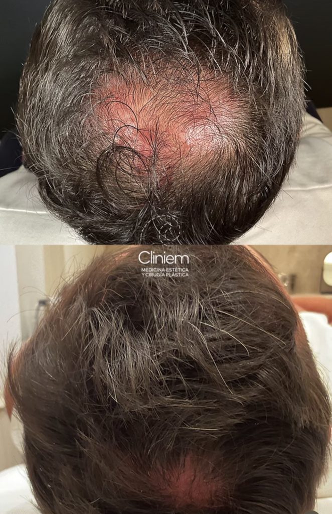 tratamientos para frenar la caída de pelo en Madrid Cliniem