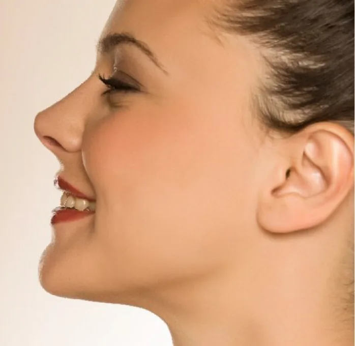 Rinoplastia ultrasónica
